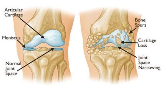 Cartilage Regeneration: Need for Medical Intervention